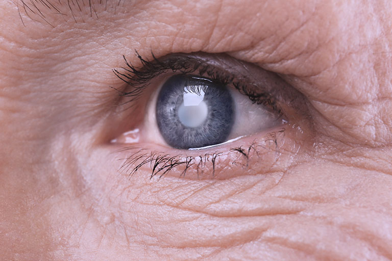 Catarata nos olhos: o que pode causar, cirurgia e orientações